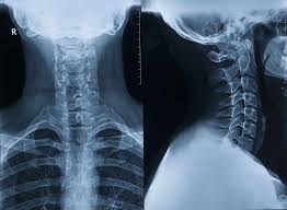 Anatomy under the right rib : Cervical Rib Anatomy Location And Treatment