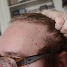 A cherry angioma is a small (a dot) to quite large, fairly common, benign (non malignant/non cancerous), bright cherry red/ purple, smooth (flat) or raised area (bump/dome), of clusters of tiny blood vessels on the skin. Are These Cherry Angioma Or Petechiae And What Is The Appropriate Treatment Photos