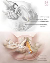 Image result for Pudendal Block