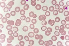 (abnormal cell with ringed appearance): Target Cells With Abnormal Red Blood Cells From Anemia Patient Stock Photo Picture And Royalty Free Image Image 99396029