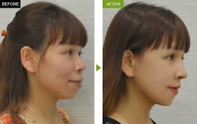 Sự khác biệt duy nhất là thứ tự các hoạt động giữa mức tăng của biến và giá trị mà toán tử trả về. Sá»± Khac Biá»t Ä'áº¿n Kho Tin Cá»§a Khuon Máº·t TrÆ°á»c Va Sau Khi Niá»ng RÄng Ho