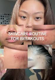 Azelaic Acid Serum: Why It's Banned in Korea?