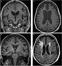 Ct and mri show no characteristic changes in lewy body dementia but can initially help rule out other causes of dementia. Brain Imaging In Differential Diagnosis Of Dementia Practical Neurology