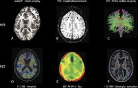 The left side of the brain is more involved with attention to the internal world. Understanding Neurodegeneration After Traumatic Brain Injury From Mechanisms To Clinical Trials In Dementia Journal Of Neurology Neurosurgery Psychiatry