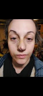 Car accident with fractured nose and stitches