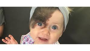 Yüzündeki lekeden kurtulmak için 7 ameliyat olacak