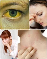 Gejala hepatitis b akut dan kronik. Pin Di Hepatitis