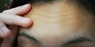 Image result for how to get rid of lines on forehead treatment not botox