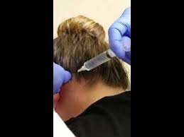 Bilateral Occipital Nerve Block Youtube Occipital Nerve Block Occipital Neuralgia Occipital