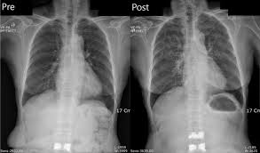 Image result for Air Bronchogram