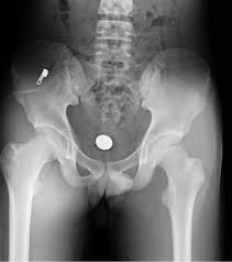 This is the first in a series of 8 blog post articles on the anatomy and physiology of the lumbar spine and pelvis. Journal Of Rehabilitation Medicine Anterior Superior Iliac Spine Avulsion Fracture Presenting As Meralgia Paraesthetica In An Adolescent Sprinter Html