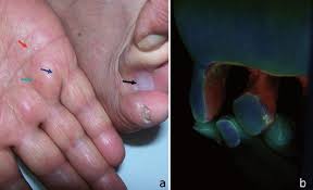 Image result for Erythrasma