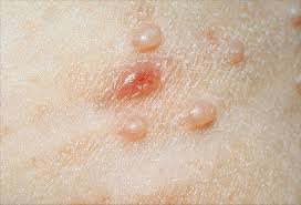 Any vesicular rash in an. Pictures Of Viral Skin Diseases And Problems Herpes Zoster
