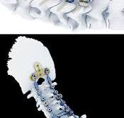 Symphony Occipito-Cervico-Thoracic System