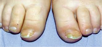 Estas debido a su tamaño pueden condicionar onicocriptosis (uñas enterradas). Alteraciones Del Pelo Y De Las Unas