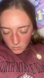 Do others get this rash?