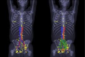 If your psa level starts to rise, this might mean the cancer has come back. Psma Pet Ct Visualizes Prostate Cancer Recurrence Early Impacts Radiation Therapy
