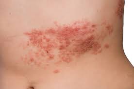Image result for shingles