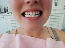 Zahnveneers Meine Erfahrung Inkl Vorher Nachher Bilder Und Kosten