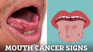 Image result for white cancer on tongue)