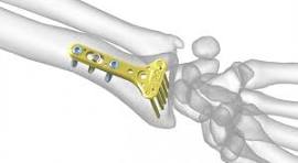 Acu-Loc Wrist Plating System | Acumed
