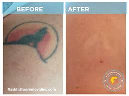 With this technology, the process becomes easier and faster.this is … Flash Tattoo Removal Inc Laser Tattoo Removal Fading Calgary