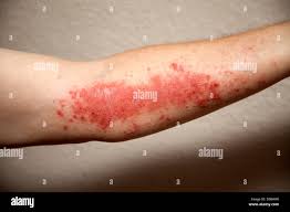 Image result for Rhus Dermatitis