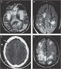Misra uk, hashmi aa, kalita j. Herpesvirus Infections Of The Nervous System Nature Reviews Neurology