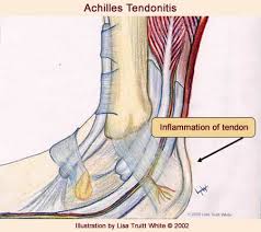 Your achilles tendon withstands a lot of stress and pressure during everyday activities, as well as during athletic. Achilles Tendinitis Indy Podiatry Michael J Helms Dpm Podiatrist Indianapolis In Foot Surgery Ankle Surgery Foot Doctor Indianapolis Foot And Ankle Specialists