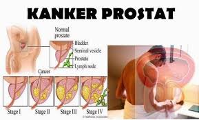 Pin Di Obat Kanker Prostat Satdium 4