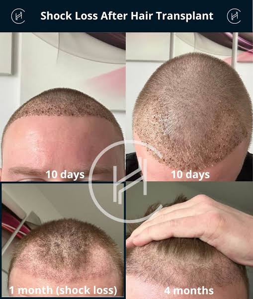 Shock Loss After Hair Transplant - Post-op Hair Shedding Timeline