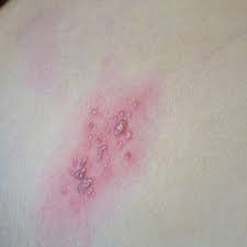 The most common side effect from the chickenpox vaccine is swelling, soreness, or redness at the site of the injection. Valacyclovir For Shingles How Effective Is It Roman Healthguide