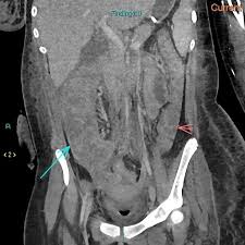 Image result for Neutropenic Colitis