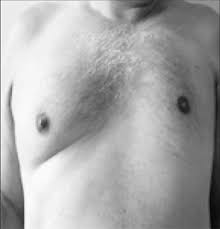 Bilateral autogenous breast reconstruction using perforator free flaps: Poland Syndrome