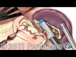A number of conditions, including liver disease and some cancers, can cause your spleen to become. Spleen Removal Surgery Laparoscopic Splenectomy Preop Patient Education Youtube