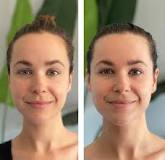 Image result for what to expect with gua sha during and after treatment