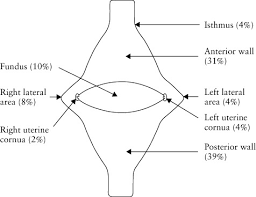 Prevalence Of Endometrial Polyps And Abnormal Uterine