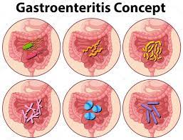 Gastroenteritis is an inflammation of the lining of the intestines caused by a virus, bacteria, or parasites. Vektorgrafiken Gastroenteritis Vektorbilder Gastroenteritis Depositphotos