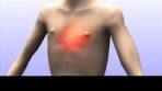 Wat is angina pectoris? - YouTube