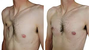 Poland syndrome is a sporadic, congenital unilateral absence of the sternocostal head of the pectoralis major muscle that can occur with other ipsilateral chest wall and limb derangements. Poland Syndrome 3d Custom Made Implant Treatment