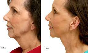 The ball waits on a path, and a spoon that rotates on an axis comes down, picks the ball up and drops it at the top. How Can Plastic Surgeons Compete With The Lifestyle Lift Calwest Surgical Institute