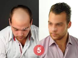 زراعة الشعر قبل وبعد 9 أشهر من عملية زرع 6500 بصيلة شعر بتقنية البيركوتان بمركز كاميليا كلينك تركيا 00905444488340 Www Camiliaclinic Com Hair Tra