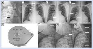 Diese hierfür einzig zugelassene pumpe ermöglicht einen konstanten fluss. A Patient With Pulmonary Arterial Hypertension And A Subcutaneous Pump Download Scientific Diagram