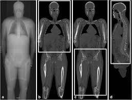 Lesser trochanter to linea aspera nerve supply:( double nerve. Value Of Low Dose Whole Body Ct In The Management Of Patients With Multiple Myeloma And Precursor States Springerlink
