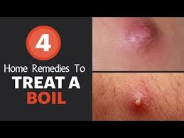 They are a common condition that if the ingrown hair bump is causing you severe irritation and pain, you should stop waxing, shaving. Many Of Us Get Confused By Taking Look At Boils And Cyst On Thigh As They Both Look Almost Same Ingrown Hair Cyst Ingrown Hair Remedies Infected Ingrown Hair
