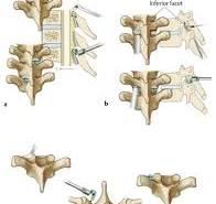 Posterior Thoracic Instrumentation with Pedicle Screws ...