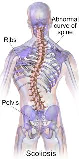 Those with scoliosis should consult their doctor before trying any exercises. Scoliosis Wikipedia