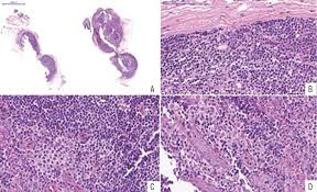 Parotid Follicular Lymphoid Hyperplasia A Rare Entity The Challenges In Differential Diagnosis