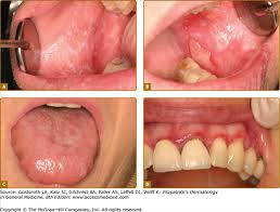 Image result for Labial mucosa