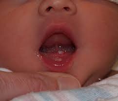 Image result for Neonatal Teeth